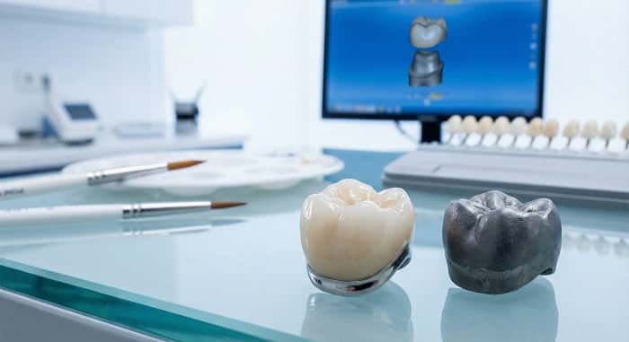 روکش فلز سرامیک: انتخاب قابل‌اعتماد برای دوام و زیبایی