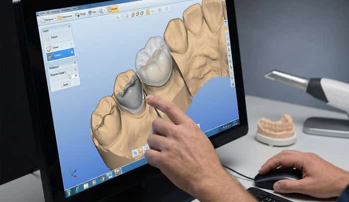 روکش فلز سرامیک: انتخاب قابل‌اعتماد برای دوام و زیبایی