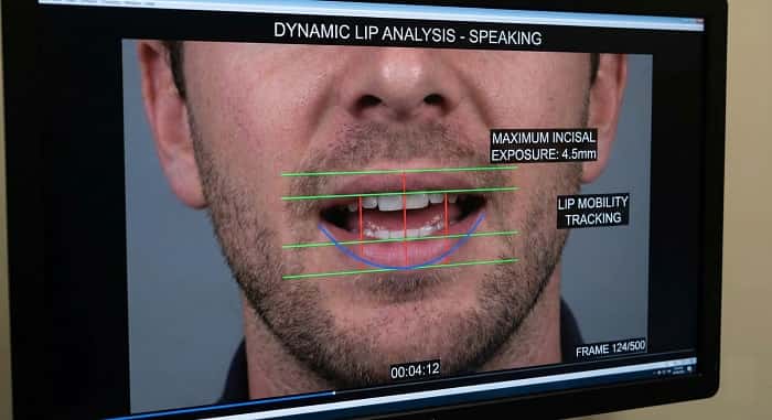 تحلیل ویدئویی لب‌ها در طراحی چهره‌محور دندانپزشکی دیجیتال