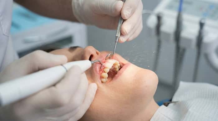 جرم‌گیری و کنترل التهاب لثه در آماده‌سازی دهان قبل از طراحی لبخند