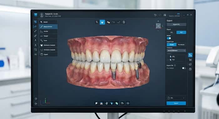 مدل سه‌بعدی حاصل از اسکن داخل دهانی و قالب‌گیری دیجیتال