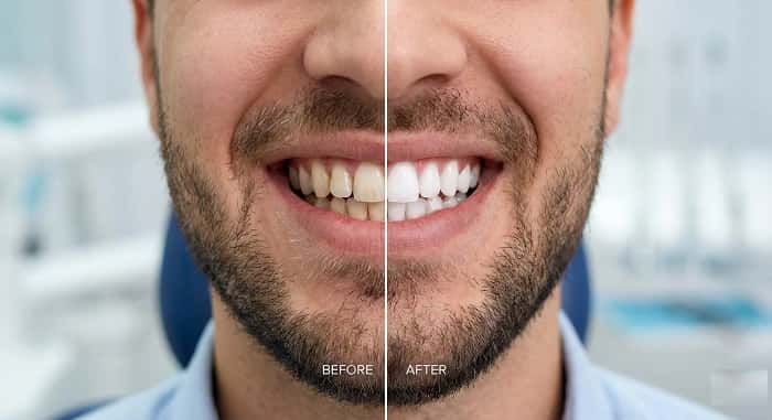 اسکن داخل دهانی در طراحی دیجیتال دندانپزشکی