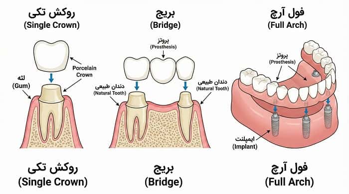 مقایسه انواع پروتز ثابت روی ایمپلنت شامل روکش تکی، بریج و فول آرچ