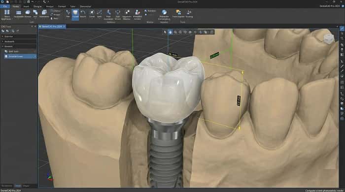 طراحی دیجیتال روکش زیرکونیا به‌عنوان پروتز ثابت روی ایمپلنت