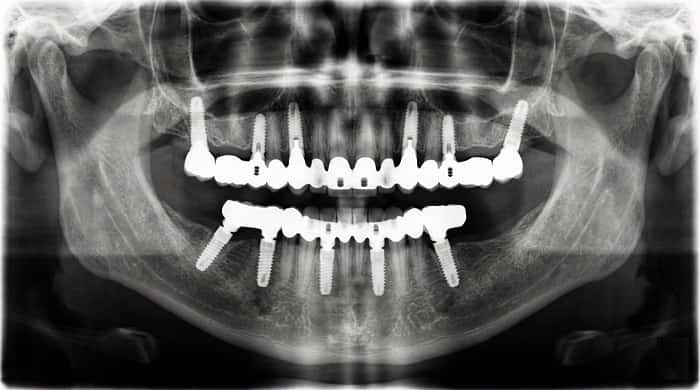 تصویر رادیوگرافی پروتز اسکرو رتین ثابت روی چند ایمپلنت در فک پایین