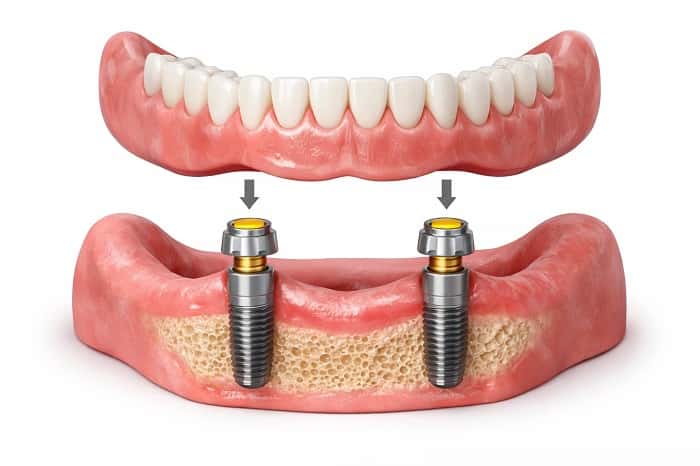 اوردنچر متکی بر ایمپلنت؛ ترکیبی از ثبات و قابلیت خارج کردن