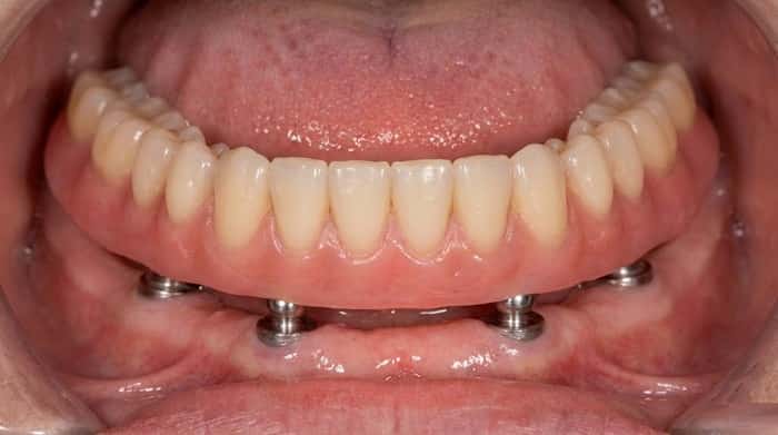 اوردنچر متکی بر ایمپلنت در فک پایین و نمایش اتچمنت‌ها روی مخاط