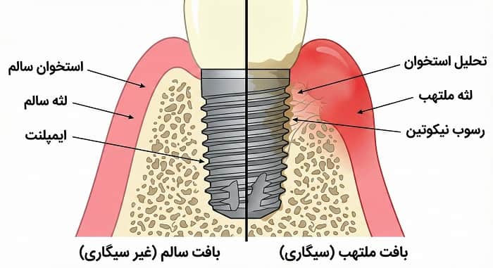 تاثیر سیگار بر ایمپلنت؛ از جوش خوردن تا ماندگاری بلندمدت