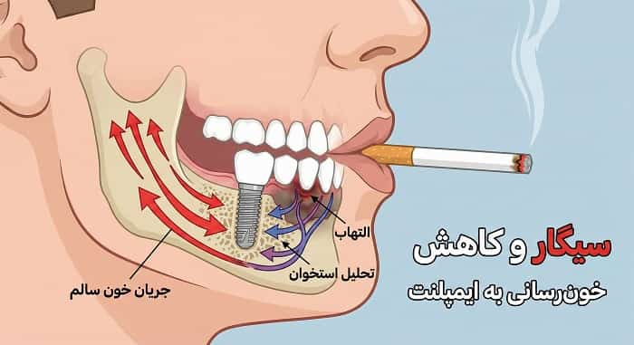 نمایش گرافیکی تاثیر سیگار و نیکوتین بر خون‌رسانی اطراف ایمپلنت