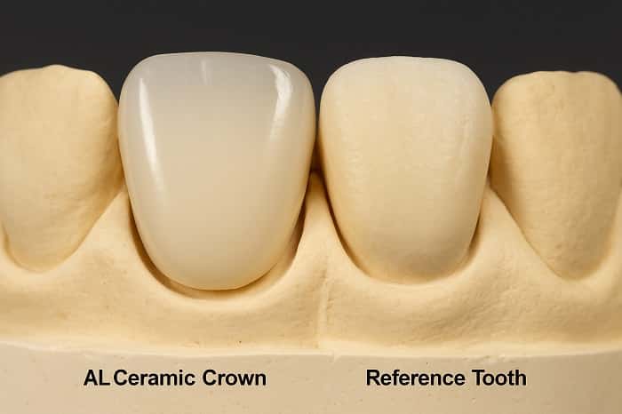 مقایسه روکش سرامیکی نهایی با دندان مرجع روی مدل دندانی