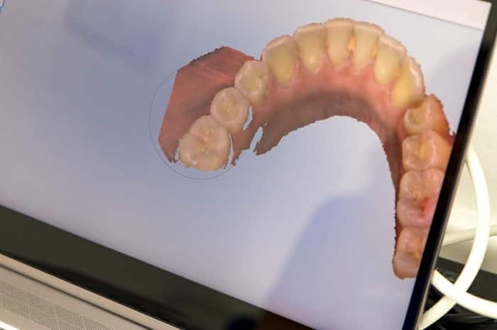 اسکن دیجیتال دندان با اسکنر داخل دهانی برای طراحی روکش زیرکونیا