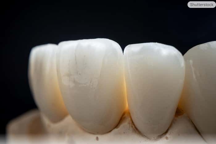 طراحی دیجیتال روکش زیرکونیا در لابراتوار دیجیتال دندانسازی