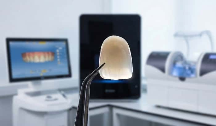 طراحی دیجیتال روکش ایمکس با نرمافزار CAD در لابراتوار دندانپزشکی