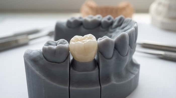 روکش زیرکونیا؛ استحکام بالا همراه با زیبایی قابل پیش‌بینی