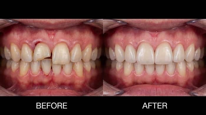 نتیجه نهایی درمان با روکش زیرکونیا در ناحیه قدامی و بهبود زیبایی لبخند