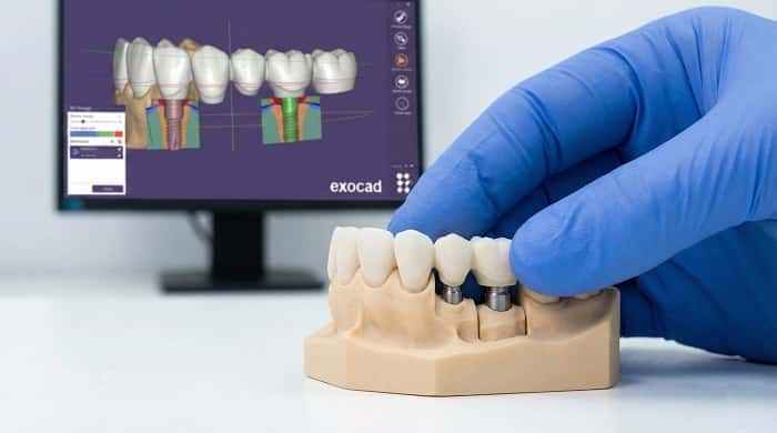 طراحی دیجیتال (CAD) در لابراتوار اسپیدنت