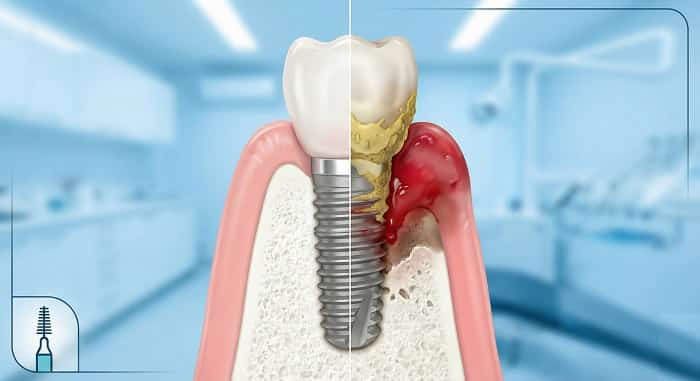 عوارض عدم رعایت بهداشت ایمپلنت؛ وقتی پلاک، دشمن پنهان درمان می‌شود