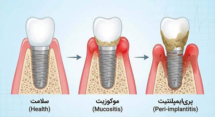 التهاب و خونریزی لثه اطراف ایمپلنت به دلیل عدم رعایت بهداشت دهان