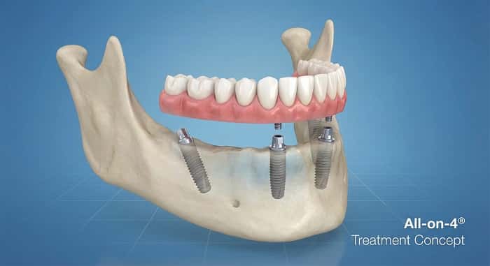 «طرح سه‌بعدی فول آرچ ایمپلنتی با سیستم All-on-4»