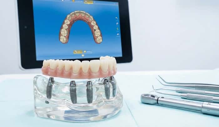 فول آرچ ایمپلنتی