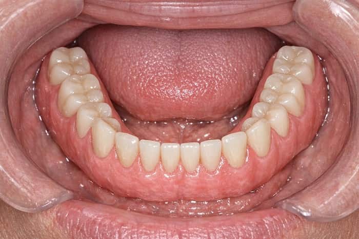 تصویر سهبعدی فول آرچ روی ایمپلنت در فک پایین با یک ردیف کامل دندان ثابت