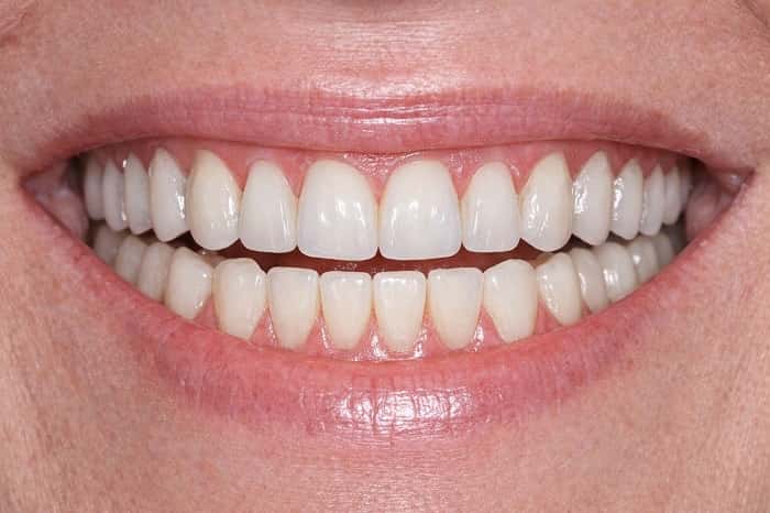 فول آرچ روی ایمپلنت چیست و در چه بیمارانی استفاده می‌شود؟