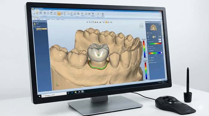 طراحی دیجیتال روکش دندانی در نرم‌افزار CAD