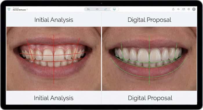 طراحی CAD در لمینت سرامیکی دیجیتال برای کنترل فرم و قرینگی