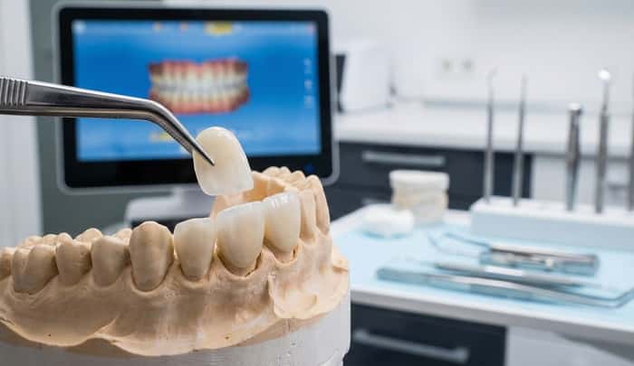 لمینت سرامیکی با ظاهر طبیعی و هماهنگ