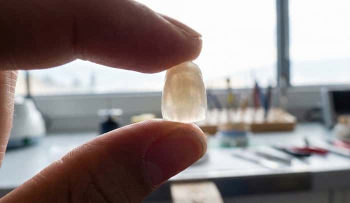 اسکن داخل دهانی برای ساخت دقیق لمینت سرامیکی