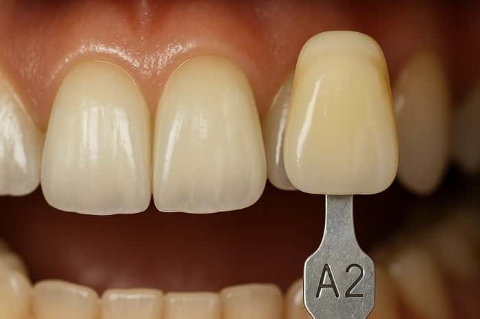 مدیریت دیجیتال رنگ و شید دندان با استفاده از اسپکتروفوتومتر در لابراتوار دندانسازی