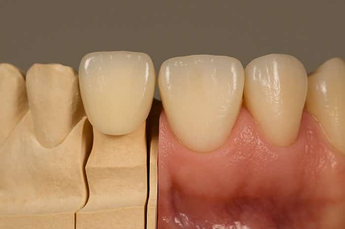 کنترل کیفیت رنگ ترمیم سرامیکی در لابراتوار تخصصی دیجیتال اسپیدنت