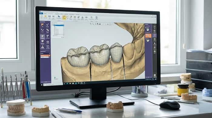 طراحی دیجیتال پروتز دندانی در نرم‌افزار CAD با نمایش مدل سه‌بعدی