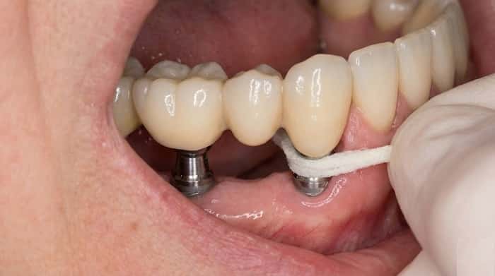 استفاده از سوپرفلاس برای تمیزکردن اطراف پروتز ثابت روی ایمپلنت