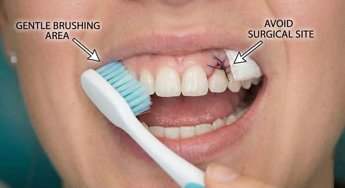 آموزش بهداشت دهان و مسواکزدن صحیح بعد از جراحی ایمپلنت