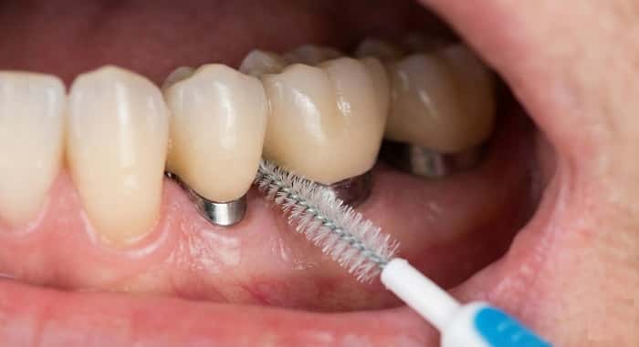 استفاده از مسواک بین‌دندانی در کنار مسواک معمولی برای بهداشت ایمپلنت