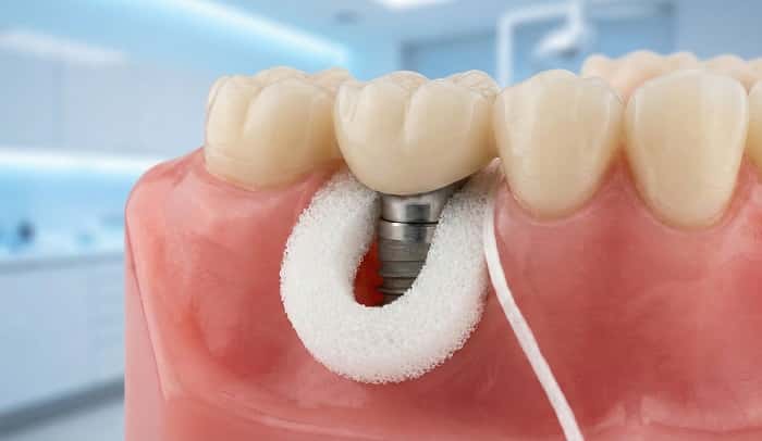 نخ دندان مخصوص ایمپلنت؛ ابزار کلیدی در بهداشت اطراف ایمپلنت