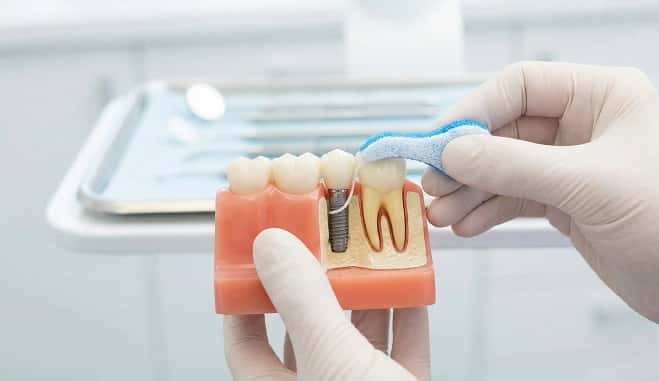 مراحل مرحلهبهمرحله استفاده از نخ دندان مخصوص ایمپلنت در خانه