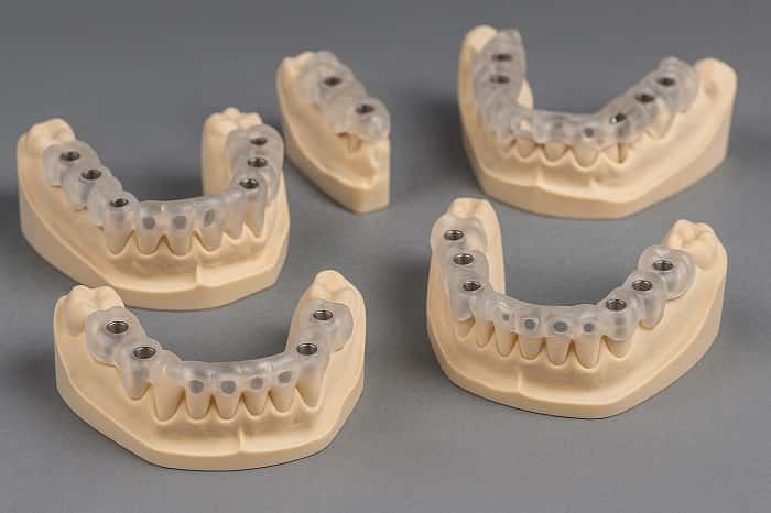 گایدهای جراحی ایمپلنت پرینت سه‌ بعدی روی مدل فک، آماده جراحی