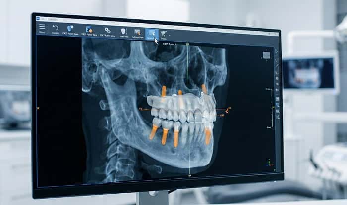 برنامه‌ریزی سه‌بعدی فول‌آرچ دیجیتال با CBCT و طراحی پروتز