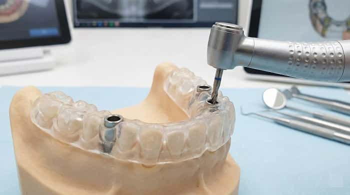 گاید جراحی در فول‌آرچ دیجیتال برای جایگذاری دقیق ایمپلنت
