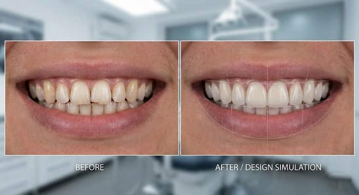 ونیر کامپوزیت و طراحی لبخند برای اصلاح فرم و هماهنگی دندان‌های قدامی