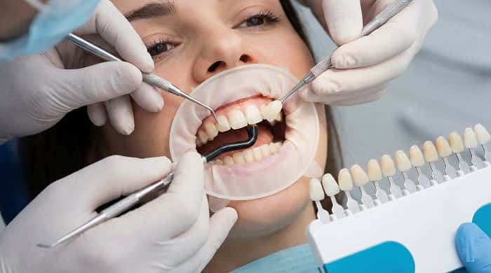 ونیر کامپوزیت برای اصلاح فرم و رنگ دندان‌های جلو