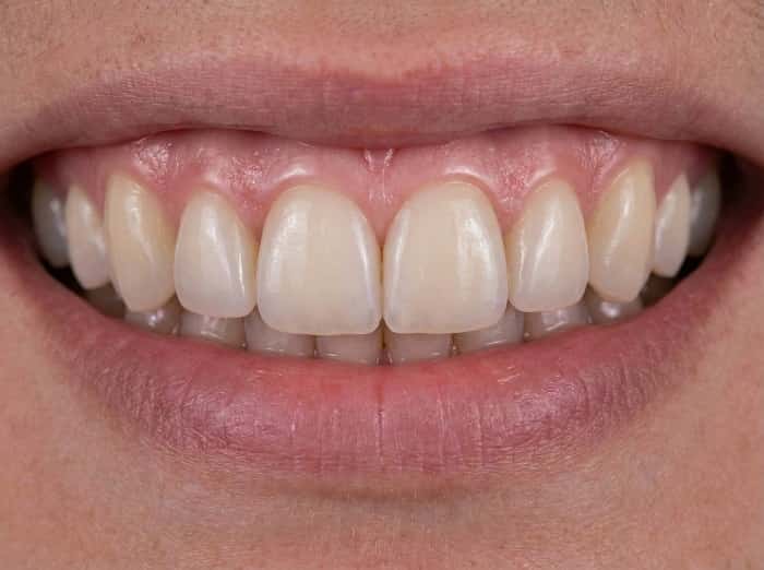 تکنیک لایه‌گذاری در ونیر کامپوزیتی برای ظاهر طبیعی