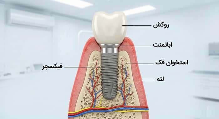 پروتز ایمپلنت چیست؟ راهنمای جامع پروتز روی ایمپلنت از نگاه لابراتوار دیجیتال
