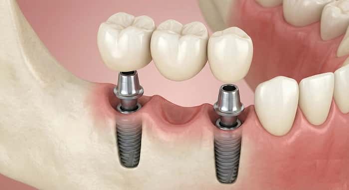 نمای کلینیکی بریج ثابت روی ایمپلنت‌های خلفی برای جایگزینی چند دندان از دست رفته