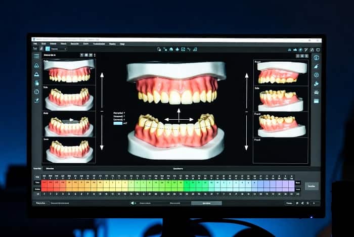 مدلهای پرینت سه بعدی استیجهای درمان الاینر شفاف در لابراتوار تخصصی دیجیتال اسپیدنت