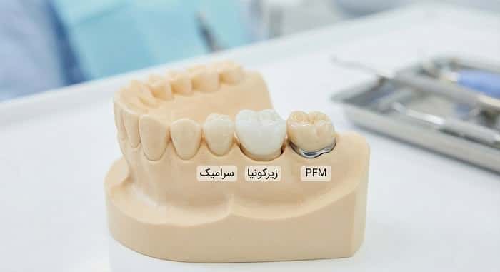 «انواع کرون دندانی سرامیکی و زیرکونیا روی مدل فک»
