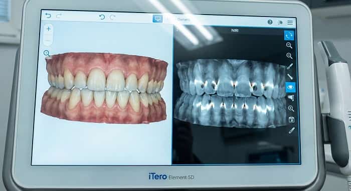 ایترُو iTero 
