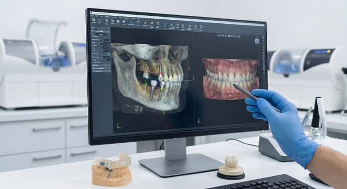 برنامه‌ریزی دیجیتال ایمپلنت چیست؟ از اسکن تا گاید جراحی و پروتز نهایی